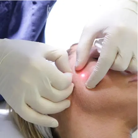 Endolaser Skin Tightening